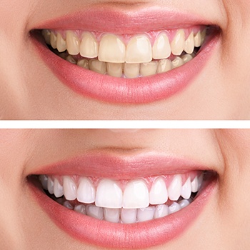 Before/after images showing the results of teeth whitening treatment